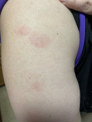 Another rash from the bed