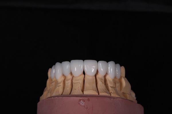 Upper porcelain veneers.