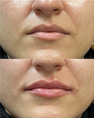 Lip filler before & after