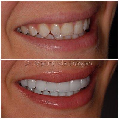 Porcelain veneers can improve a smile.  Dr. Martirosyan is the best cosmetic dentist in Glendale, Burbank & Pasadena area.