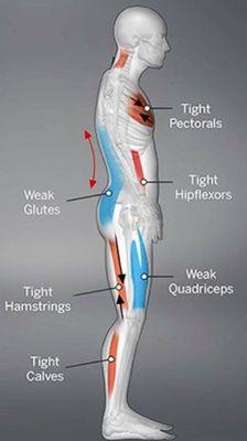 Great picture illustrating common muscle imbalances leading to dysfunction and pain. Allow me to help you regain your life!