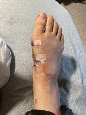 Infection on my right foot.