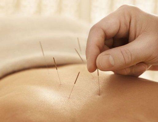 Acupuncture at River Family Wellness