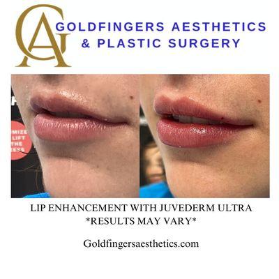 Lip Filler