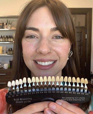 Patient Rachel showcasing WhiteNows whitening levels post care.