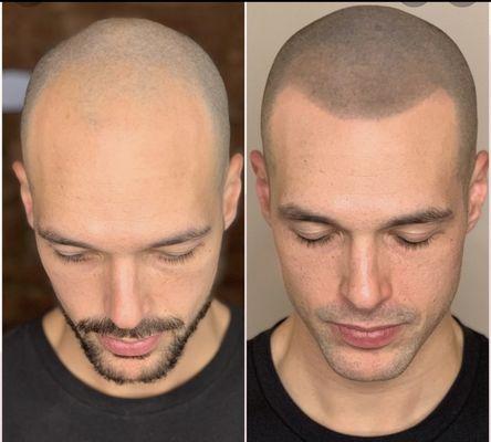 Another fabulous example of what Scalp Savant treatments can do for you and your hair restoration desires. Call us now.