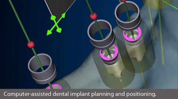 Computer guided dental implant placement - minimally invasive!