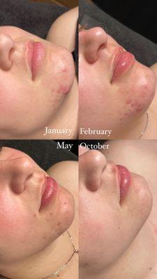 Face Reality Acne Bootcamp Progress