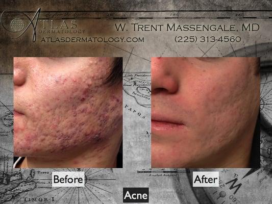 Acne treatment