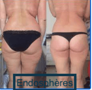 Endosphères treatment to reduce cellulite