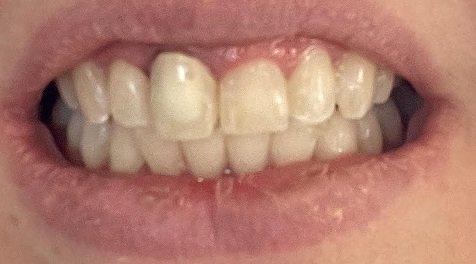 My temporary tooth by Dr. Stoddart