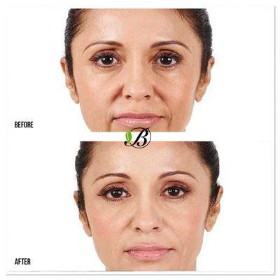 Radiesse is an injectable filler that can add fullness or minimize fine lines and wrinkles in the face or hands.