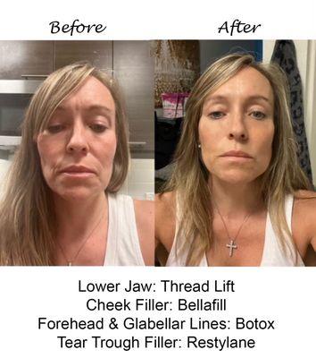 Thread Lift, Bellafill, Botox and Restylane Client Results