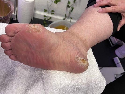 Excessive callus built up AFTER PICTURE! We take extreme measures to cosmetically help you BEAUTIFY your feet/nails. @jynails