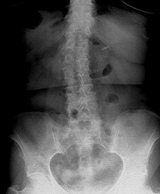 Scoliosis of patient.