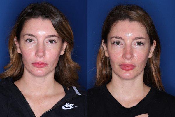 34 year old female 7 months post op from lower eyelid blepharoplasty with fat transpositions