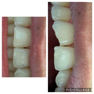 Before and after tooth bonding procedure