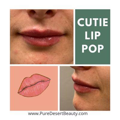 Lip filler