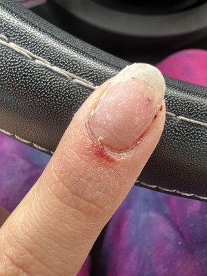 The red clot at the end of of the nail is blood from the nerve under my nail from the overfilling and burning from the electric filer