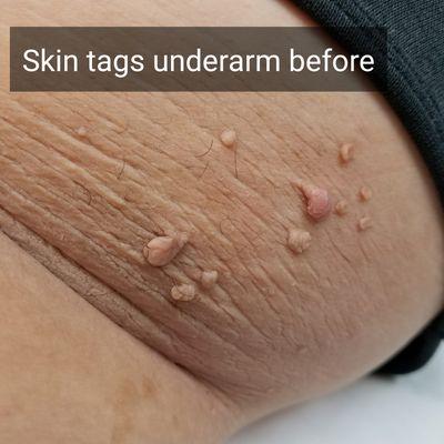 skin tags