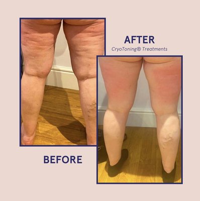 Cellulite reduction... one treatment!