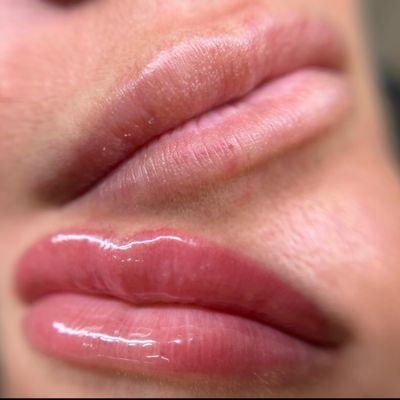 Hydra lip gloss procedure .