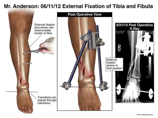 First of two serious surgeries on my client's Tibia/Fibula after motorcycle crashed caused by drunk driver.