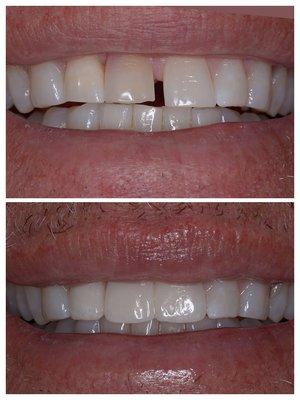 Strong and natural looking porcelain bridge to replace front tooth