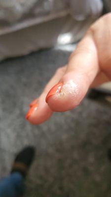 Pus coming out of her finger