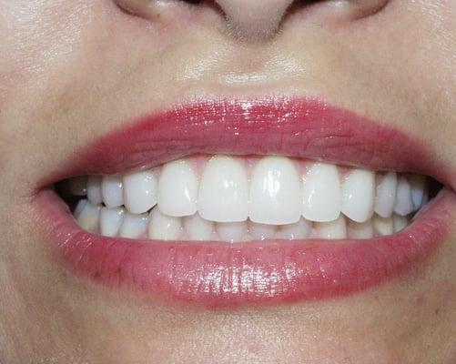 With Veneers Dr. Joel Singer was able to enhance Ana's smile to a natural Whiter, Brighter smile.