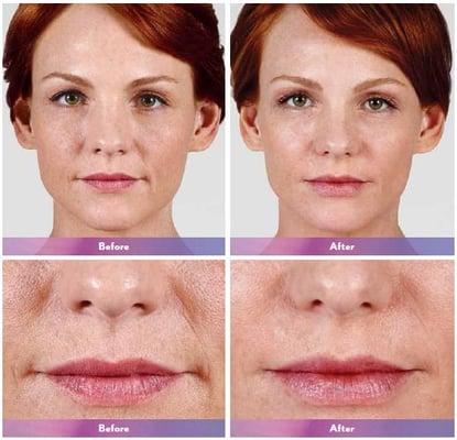 We offer Juvederm® for the only lip injection proven to last for over a year!