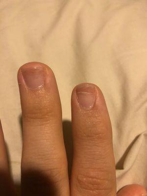 Split nails