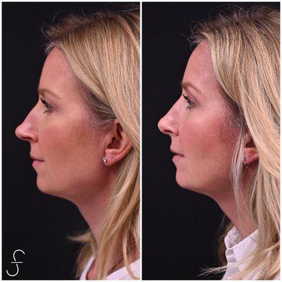 Rhinoplasty