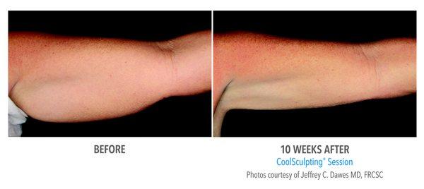 Check out these amazing Coolsculpting results!