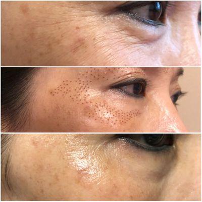 Fibroblast skin tightening and remove fine lines under eyes. Before/right after treatment/ 4weeks after treatment