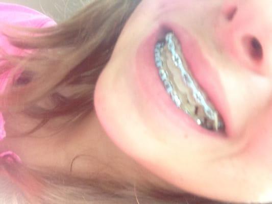 I love my braces :)