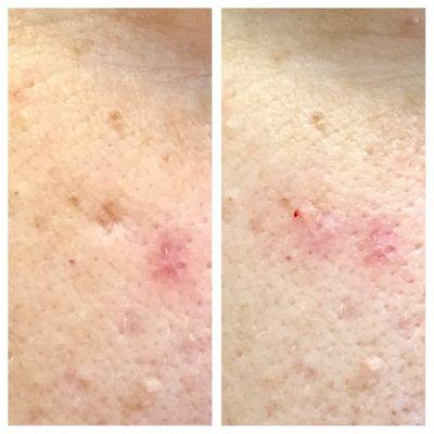 Acne scar reduction using dermal filler.