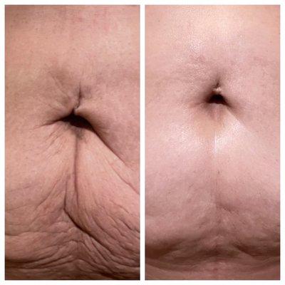 Before and After of abdomen after 6 sessions of Evolve