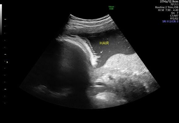 Want to know if your baby has hair? We can start looking for hair around 28 weeks in 2D imaging!