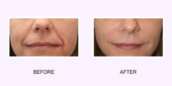 Facial line reduction via injectable filler