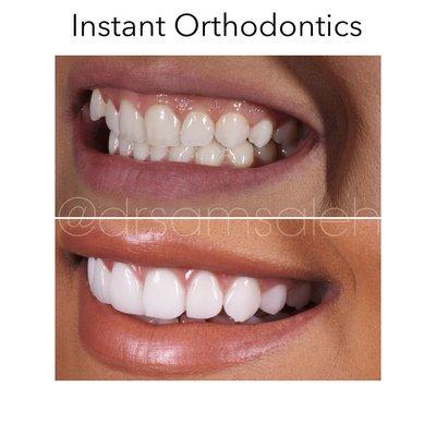 Porcelain Veneers to correct position, size and color of teeth.