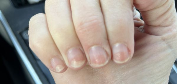 Nail damage from drill used at salon to remove gel polish