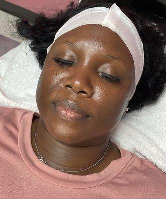 Glowing skin after Dermaplaning Facial