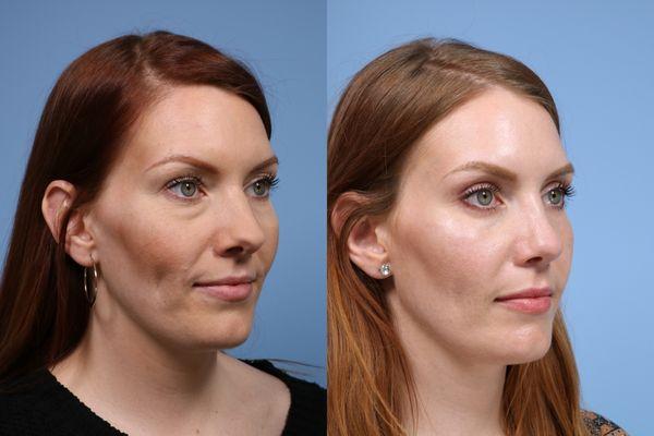 Rhinoplasty at L&P Aesthetics