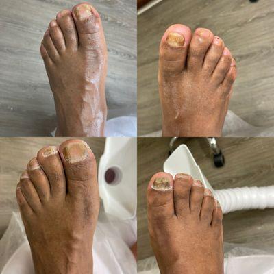 Before and after diabetic foot care