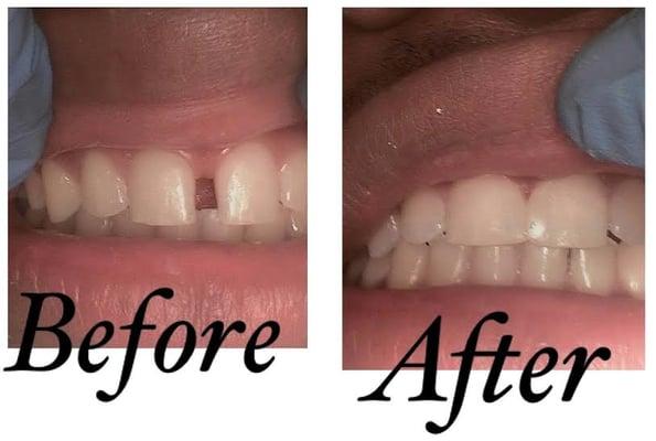 This patient was unhappy with the space between his teeth (known as a diastema).