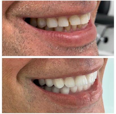 Full mouth smile makeover