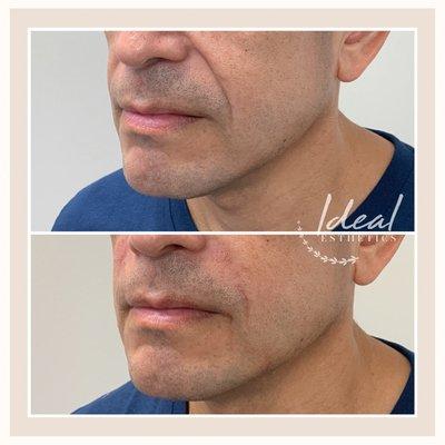 Before and after filler treatment in smile lines