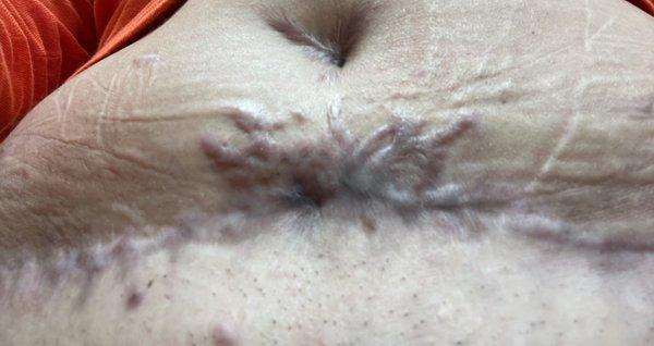 Post tummy tuck Dr. Kesler. Not even a refund after spending $16k to look like this.