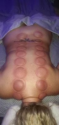 Cupping